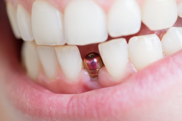 Tips To Get Ready For Dental Implant Surgery