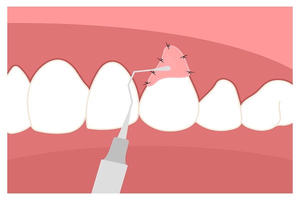 Reasons Why A Gum Grafting Procedure May Be Recommended For You