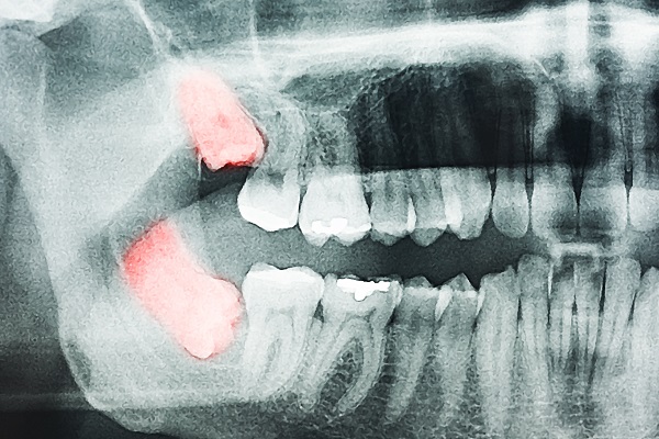 Wisdom Tooth Extraction The Woodlands, TX